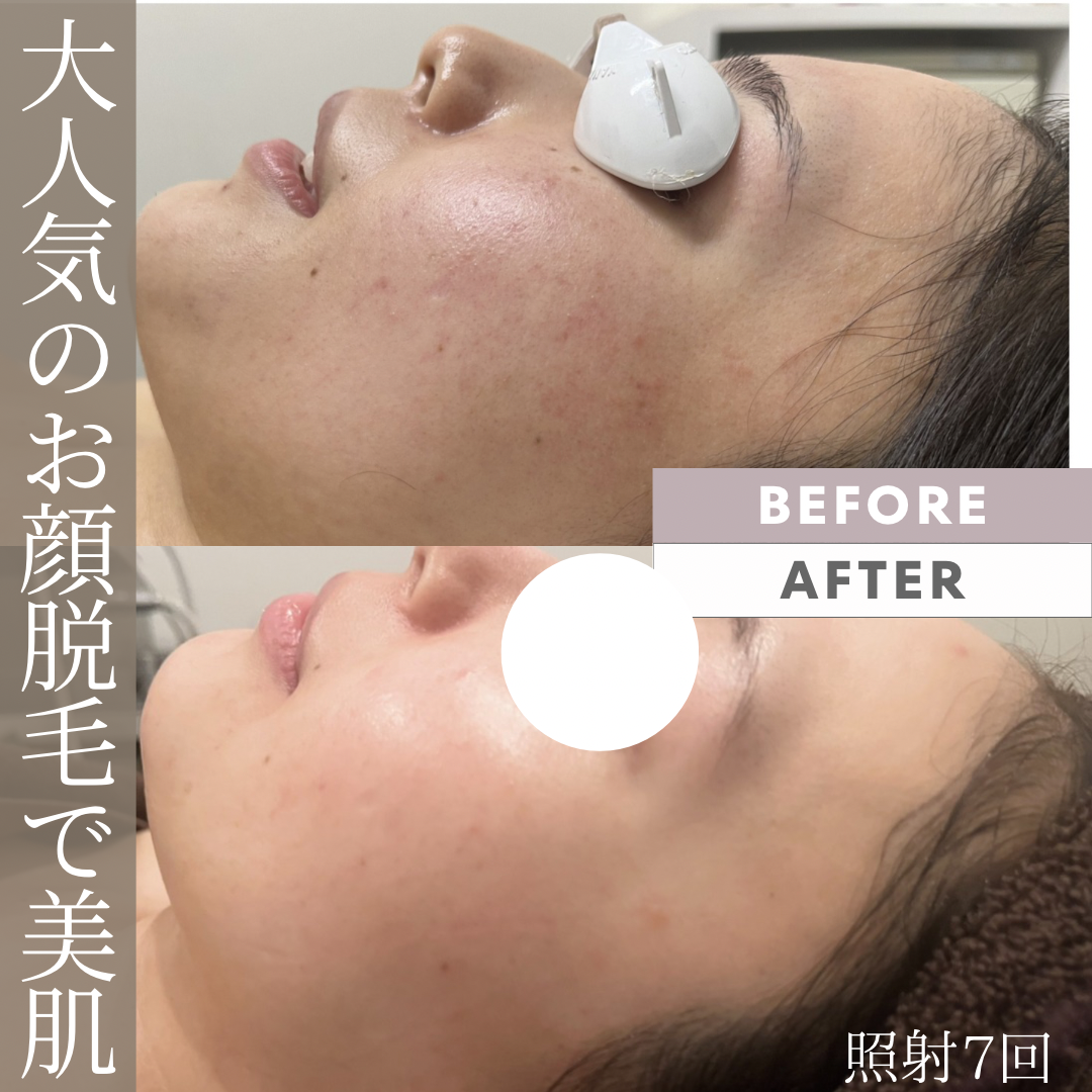 シンプル　写真　ビフォーアフター インスタグラム投稿 アイラッシュ　美容.PNG