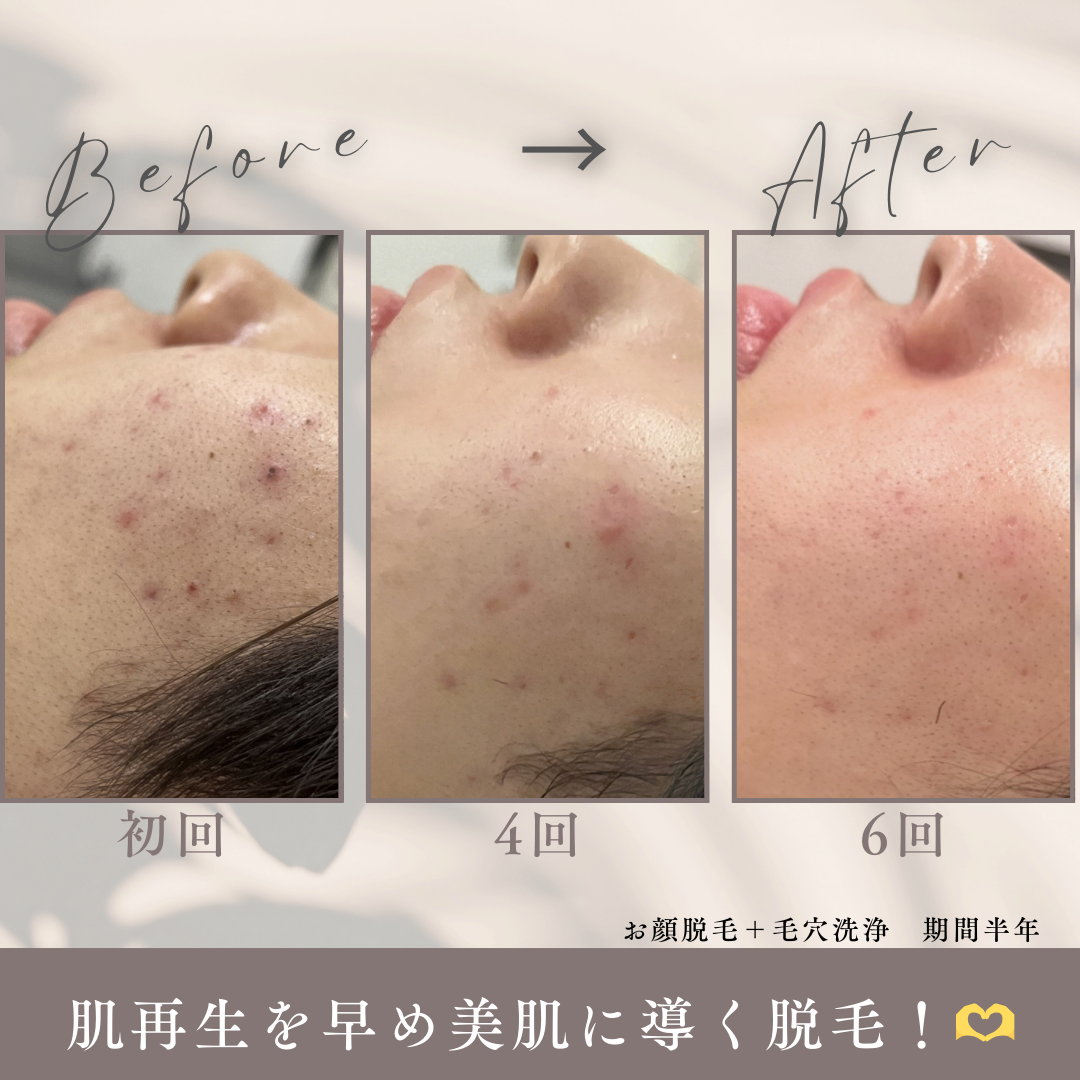 グレー　シンプル　美容　エステサロン　ビフォーアフター　写真　Instagram投稿　.png.PNG