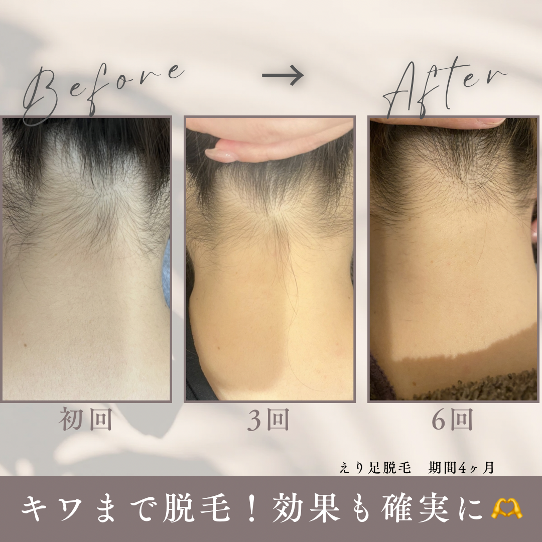 グレー　シンプル　美容　エステサロン　ビフォーアフター　写真　Instagram投稿.PNG