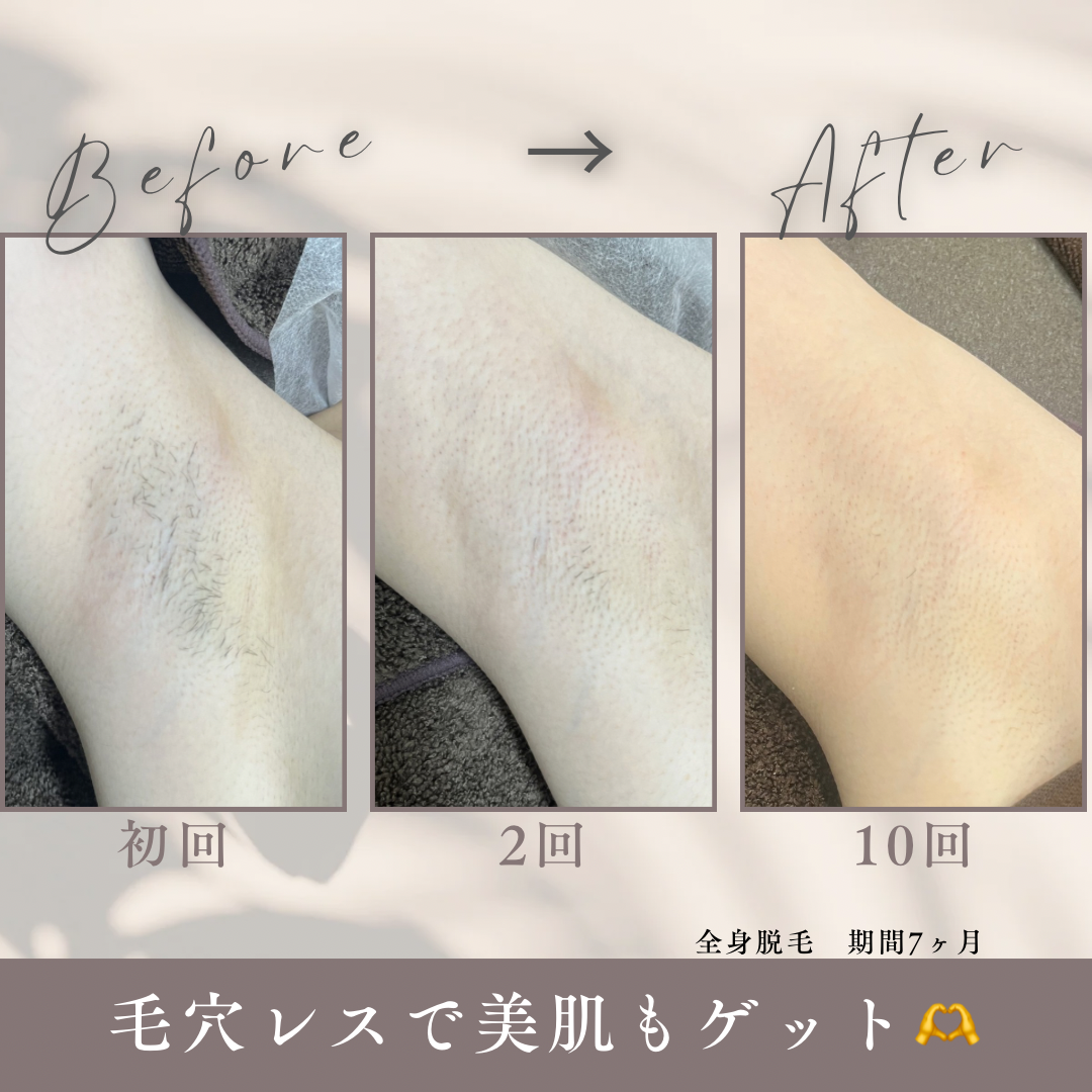 グレー　シンプル　美容　エステサロン　ビフォーアフター　写真　Instagram投稿.PNG