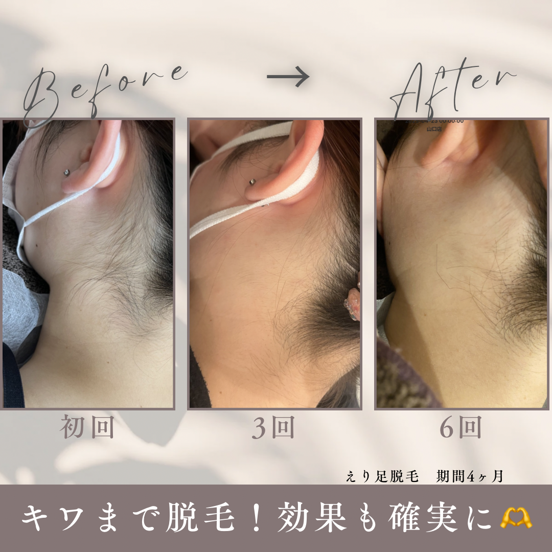 グレー　シンプル　美容　エステサロン　ビフォーアフター　写真　Instagram投稿.PNG