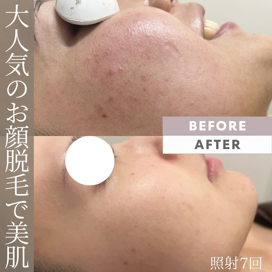 シンプル　写真　ビフォーアフター インスタグラム投稿 アイラッシュ　美容 .png.PNG