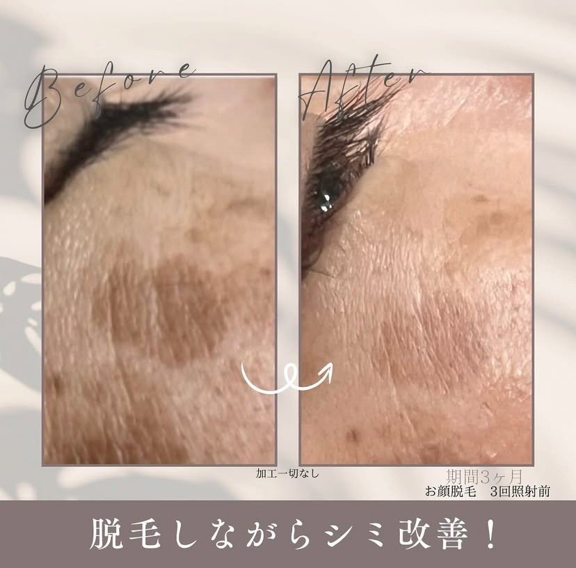 お顔脱毛.jpg