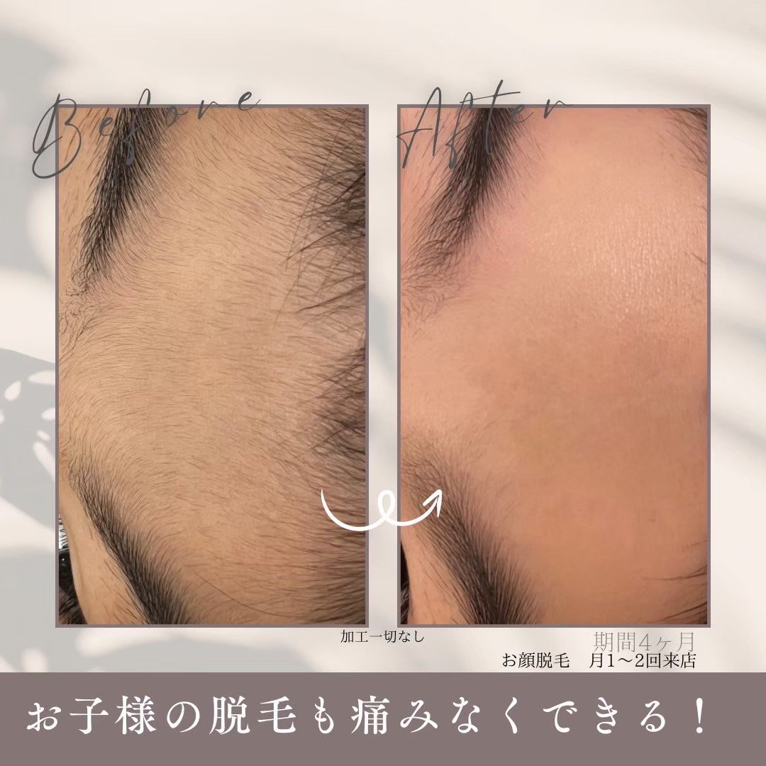 お子様脱毛.jpeg