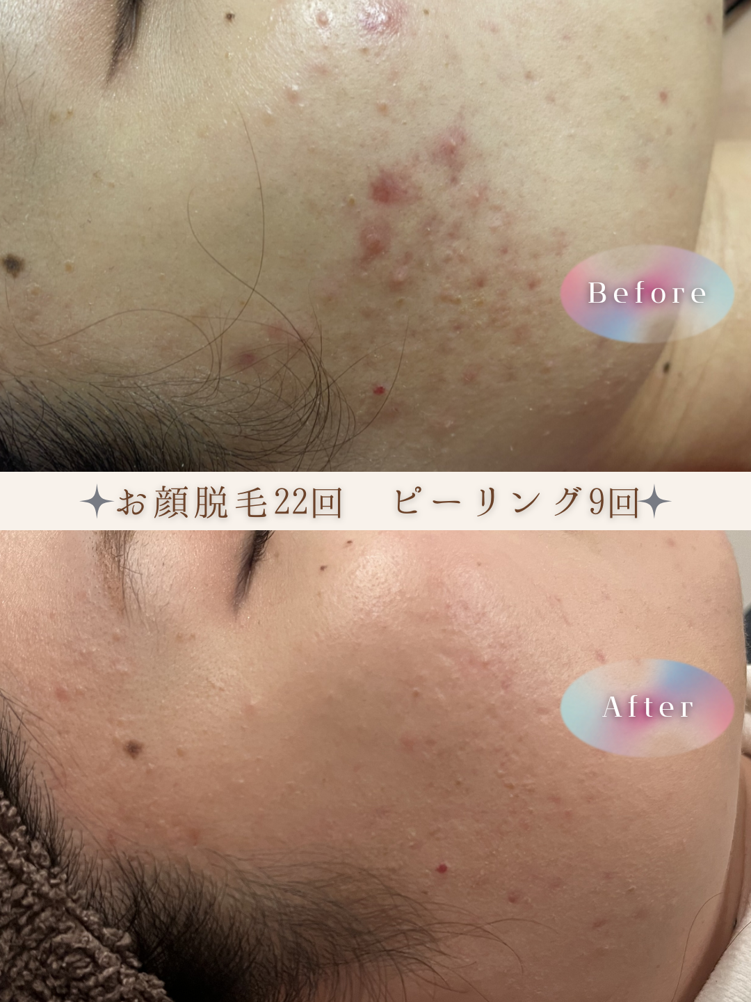 ブラウン　シンプル　美容　ビフォーアフター　写真　Instagram投稿　 (Instagramの投稿（34）).PNG