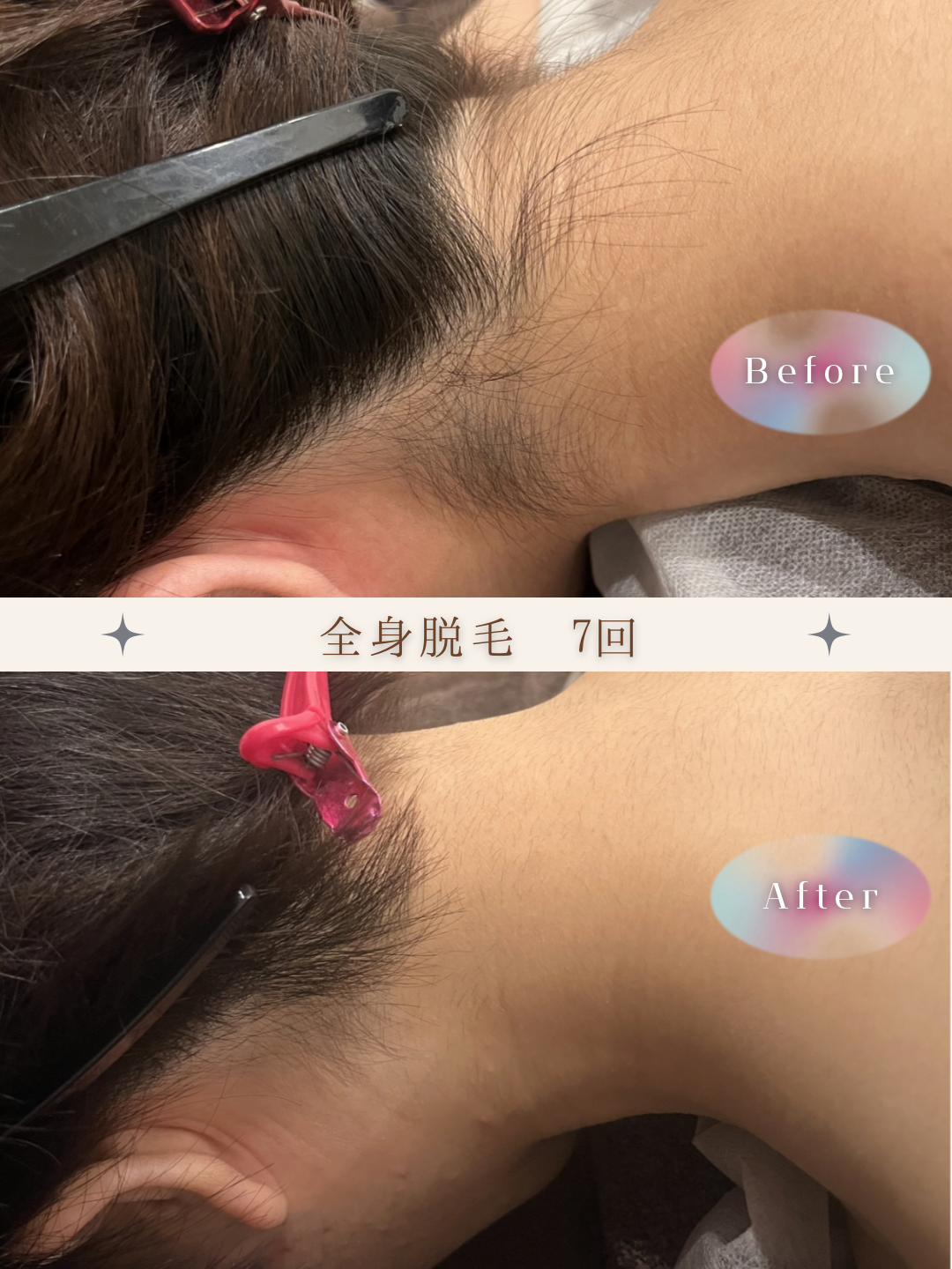 ブラウン　シンプル　美容　ビフォーアフター　写真　Instagram投稿　 (Instagramの投稿（34）).PNG